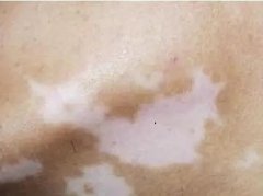 白癜风发病期的症状有什么