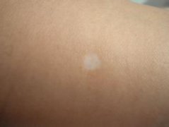 白癜风怎样预防的方法