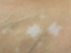 白癜风预防的方法怎样