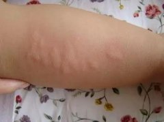 荨麻疹要注意什么问题
