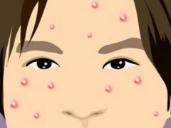 预防痘痘的措施有哪些