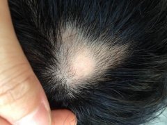 斑秃会产生什么的影响