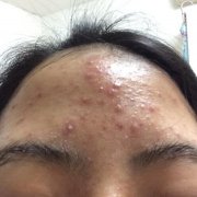 怎么老是长青春痘