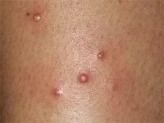 头上毛囊炎的护理