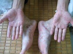 脚气怎么护理方法