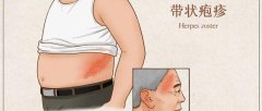 生活如何预防带状疱疹