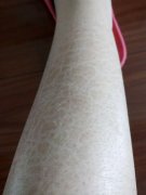 鱼鳞病饮食忌口怎么样
