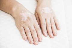 白癜风发病期前兆怎么样