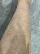 鱼鳞病产生危害有哪些