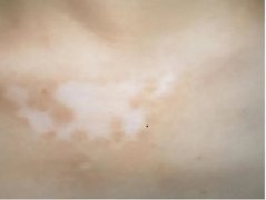 白癜风患者需要治疗方法