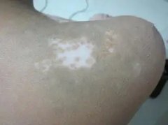 白癜风患者护理皮肤怎么做
